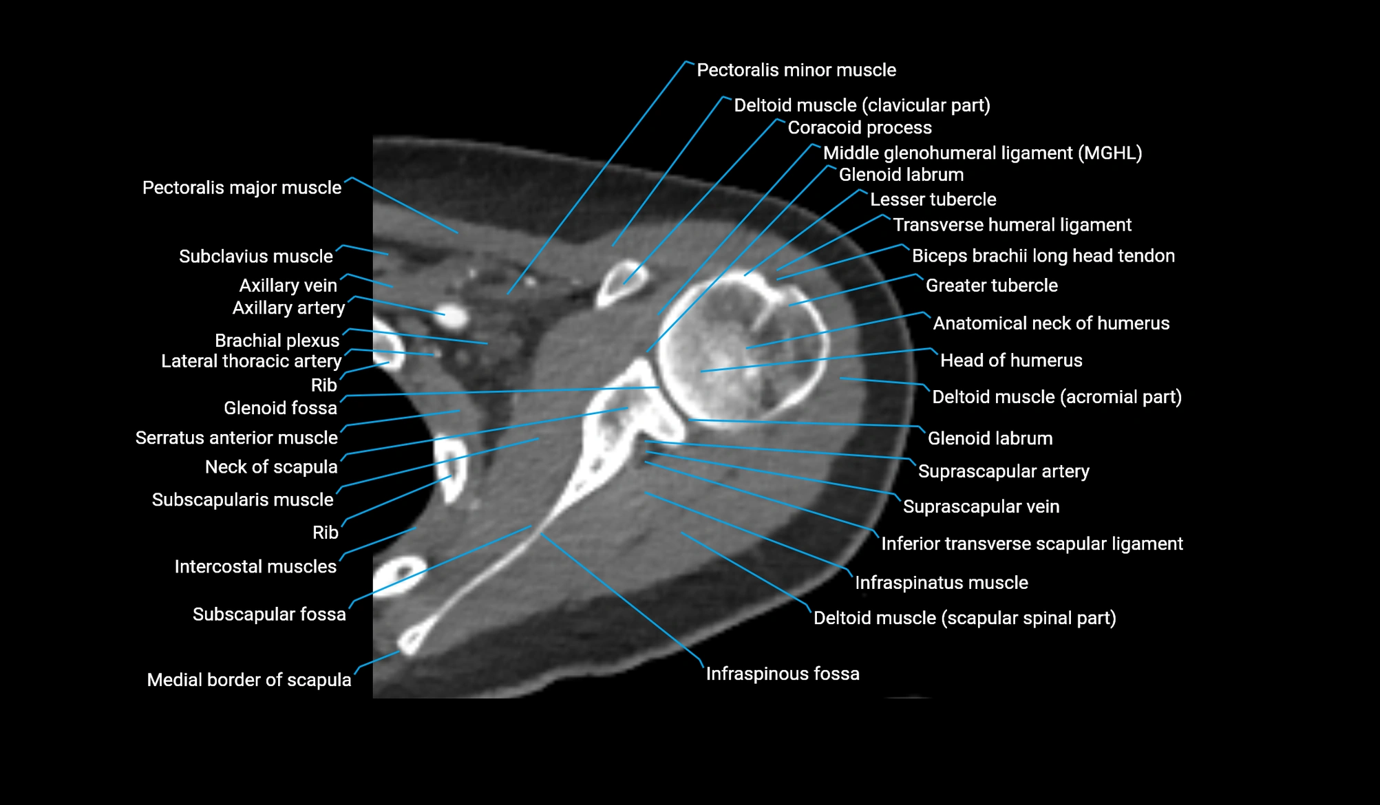CT upper arm axial  cross sectional anatomy labelled radiology image -00090.webp